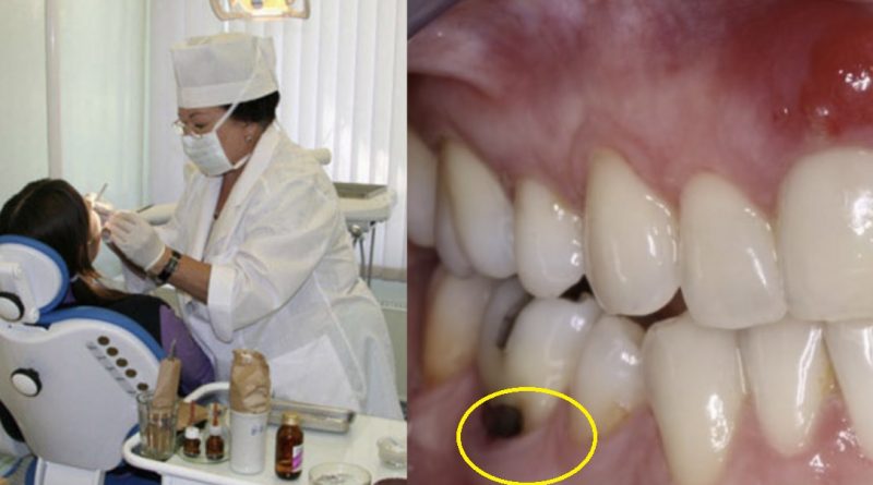 Заліз через ясна: стоматолог під пломбою виявила кліща, який заразив жінку старшною хворобою (фото)
