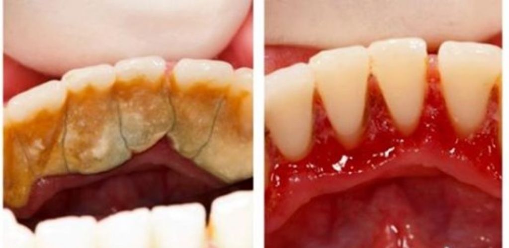 Стоматологи вам цього не скажуть: Є один спосіб щоб позбутися від зубного каменю вдома!