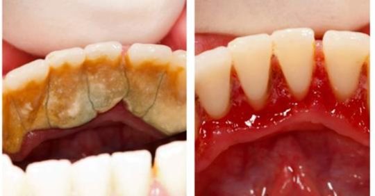 Жоден стоматолог Вам цього не скаже: Є один спосіб щоб позбутися від зубного каменю самому і вдома!